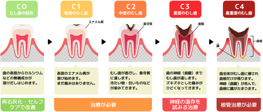 中野駅南口徒歩3分の「おとデンタルクリニック」では、むし歯の進行段階に応じて適切な治療を行い、できる限り歯を削らず残すことを重視。精密な診断と丁寧な説明で、安心のむし歯治療を提供します。