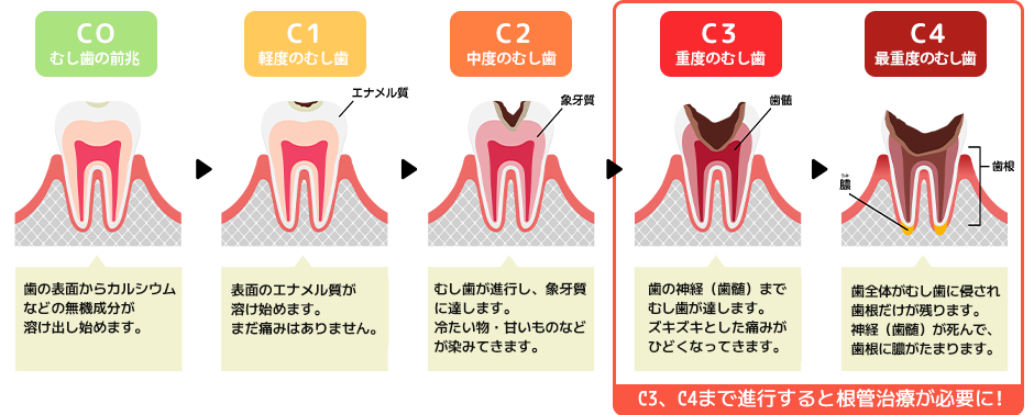 中野駅南口徒歩3分の「おとデンタルクリニック」では、進行したむし歯に対しても精密根管治療を行い、可能な限り抜歯を回避しています。歯を残すことで、将来的な口腔環境の健康維持につなげています。