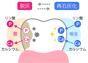 初期の段階であれば削らずに再石灰化を目指せます