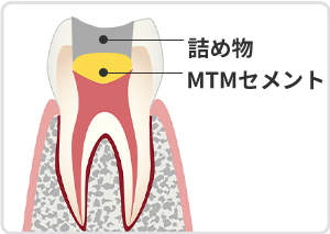 MTAセメント（覆髄治療・神経保存治療）※自費