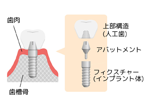 2ピースタイプの構造