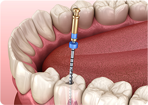 根管治療とは歯の根っこの治療のことです