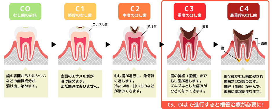 むし歯の進行と根管治療